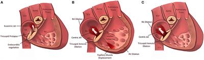 Secondary Tricuspid Regurgitation: Pathophysiology, Incidence and Prognosis